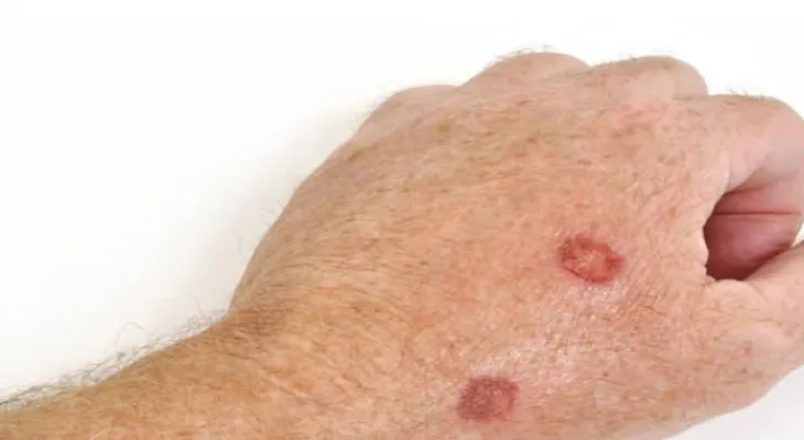 Canadian concern after the rise in skin cancer rates among males