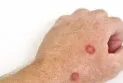 Canadian concern after the rise in skin cancer rates among males