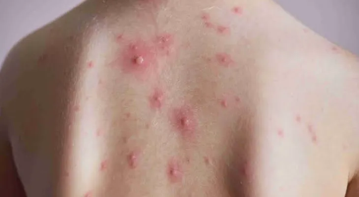 Canadian concerns after the rise in smallpox cases in Ontario