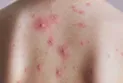 Canadian concerns after the rise in smallpox cases in Ontario