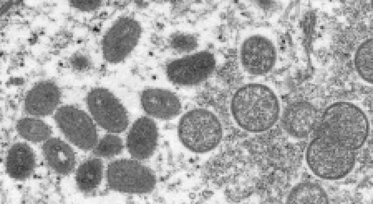 Officials: Toronto is witnessing a rise in cases of "monkeypox"