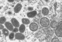 Officials: Toronto is witnessing a rise in cases of "monkeypox"