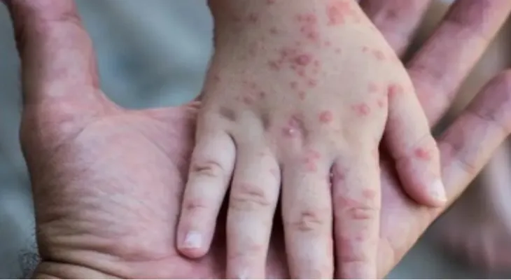 After the declaration of a state of emergency.. What is monkeypox and how does it spread