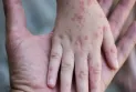 After the declaration of a state of emergency.. What is monkeypox and how does it spread