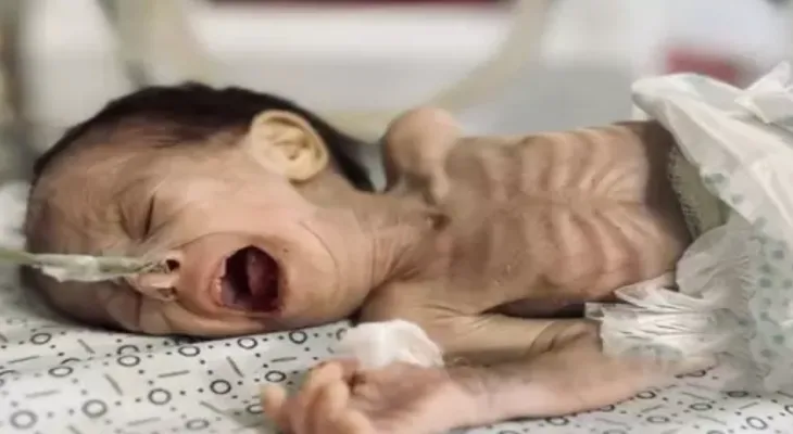 UN Report: Global Hunger Crisis Reached Its Peak in Gaza Strip
