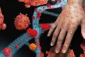 A new variant of the monkeypox virus is changing perceptions about its spread and severity.