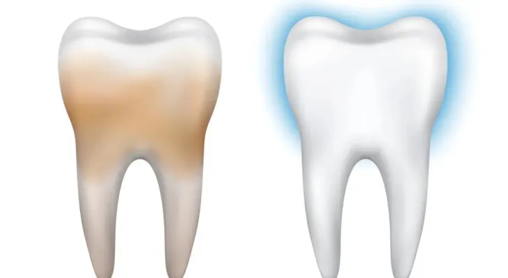 7 home remedies to remove yellow stains from teeth