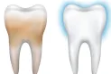 7 remèdes maison pour éliminer les taches jaunes des dents