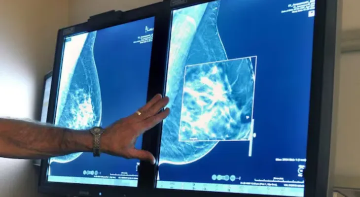 Ontario: New, breast imaging starting at age 40 without a doctor's referral