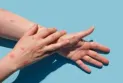 Santé française : enregistrement du premier cas de la nouvelle variante de la variole du singe