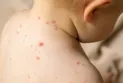 Hausse des cas de rougeole en Ontario à environ 200 avec la propagation du virus à travers le Canada